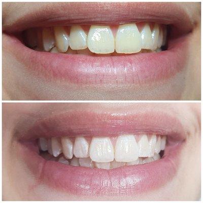 Teeth whitening service !