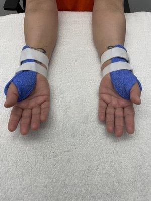 Custom Splint for Dequervain's Tenosynovitis (texting thumb)