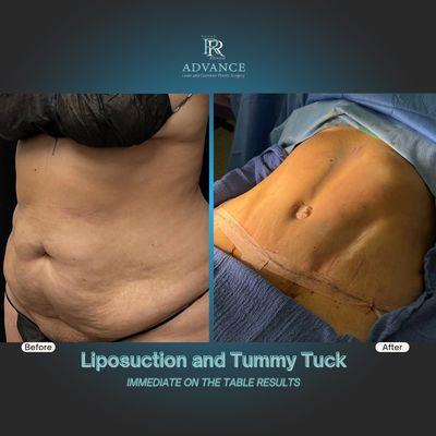 Tummy Tuck with Liposuction