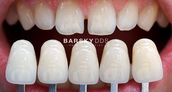 Dental Veneer color selection.