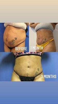 Tummy tuck