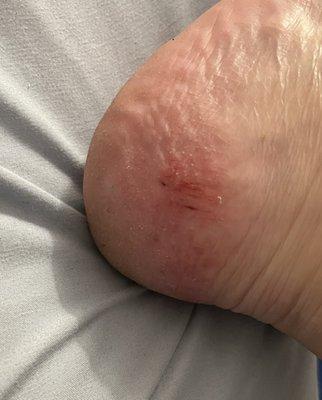 Side of my heel