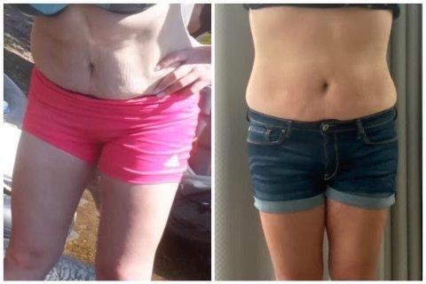 Before & After Láser Lipo Treatment