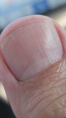 Right thumb, dull and crooked cut