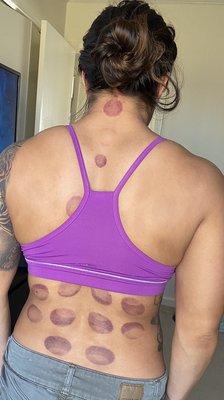 Cupping with deep tissue massage