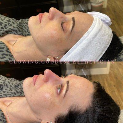 Ice Globe Facial