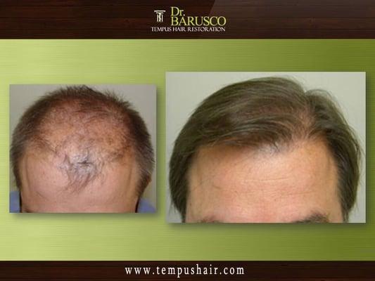 Dr. Marco Barusco actual patient before and after photo. Natural results!