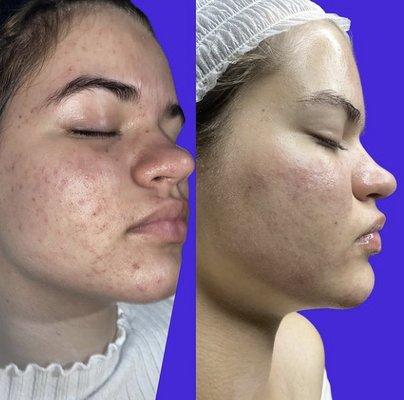 Acne Facial