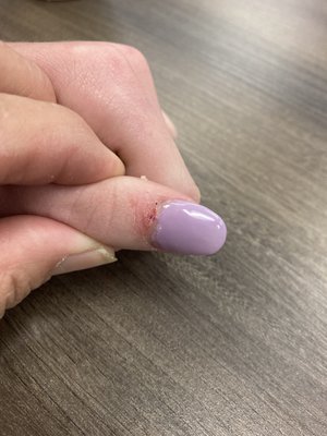 Tech cut the skin on my granddaughter's thumb and it bled.