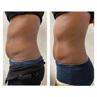 Results from one Lipo360 session