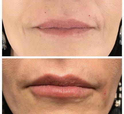 Subtle look for a more discreet patient who wanted a bit more lips but still look very natural. Loved them!