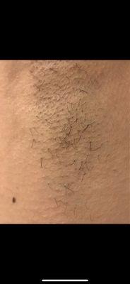 Before photo of underarm sugaring hair removal