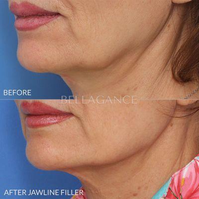 Jawline filler to help reduce the appearance of the jowls. Filler is placed in front and behind the jowls to create a straighter profile.