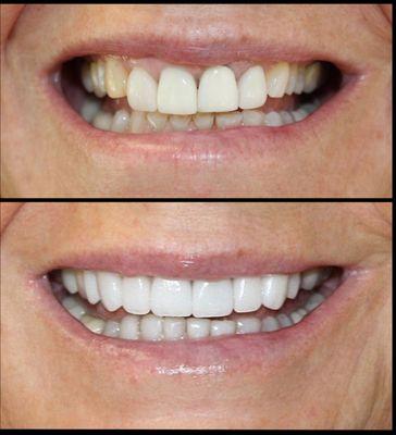 Veneers and Crowns