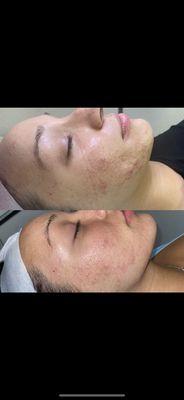 One session of Microneedling