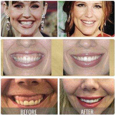 Let Botox help rid you of your overly gummy smile.