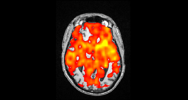 Arterial Spin Labeling (ASL) MRI scan of patient with early dementia showing signal drop out in posterior aspects of brain