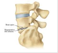 Degenerative Disc Disease