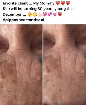 Before and immediately after her FIRST bio active peel!!!