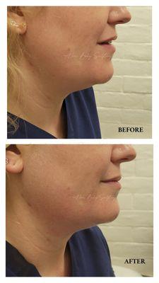 A more define jaw after 1 treatment of Radio Frequency