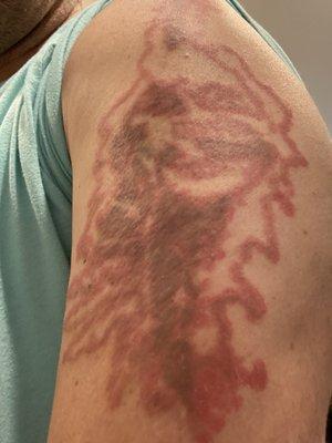 Removery Tattoo Removal & Fading