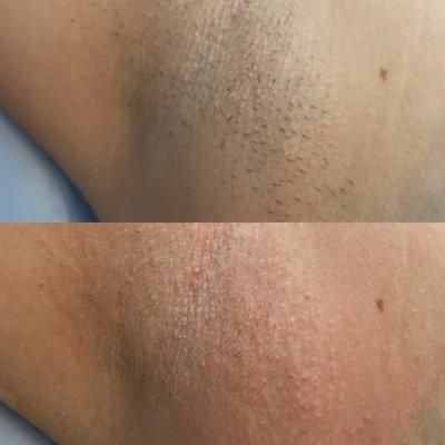 sugaring hair removal