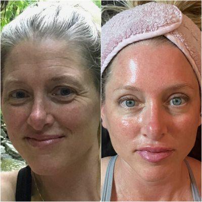 Skin transformation