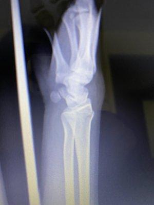 X-ray of broken radius