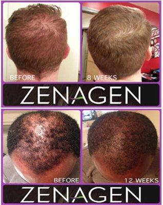 ZENAGEN Hair Thickening Treatment for men and women