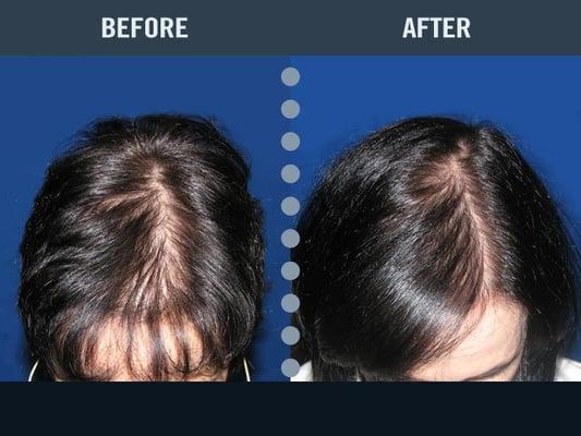 After using laser treatments and HLCC products, this patient had tremendous success in growing back her hair and stopping hai...