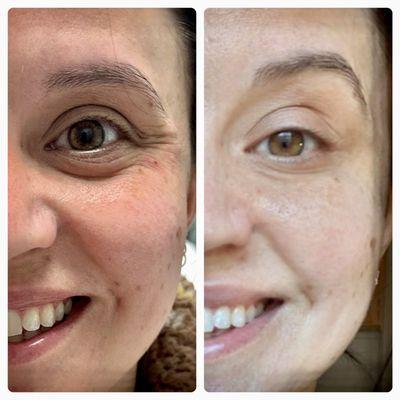 Before and after treatment of crows feet and lower lid lines using xeomin injections