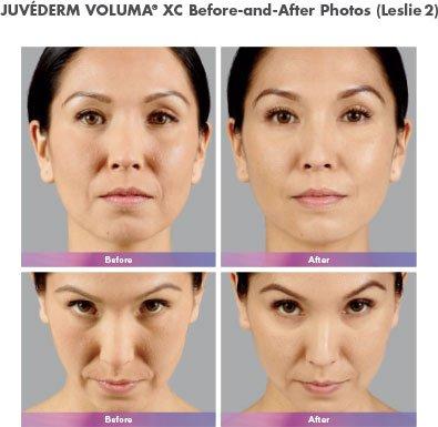 Juvederm / Skin Tightening in Washington, DC 20006