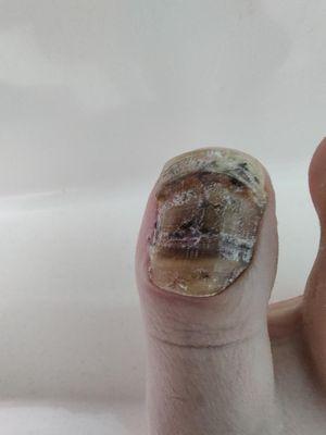 horrendous aftermath of corner procedure done without permission or explanation