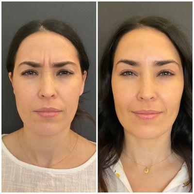 Before/After of Daxxify, a long lasting peptide-powered treatment to treat frown lines.