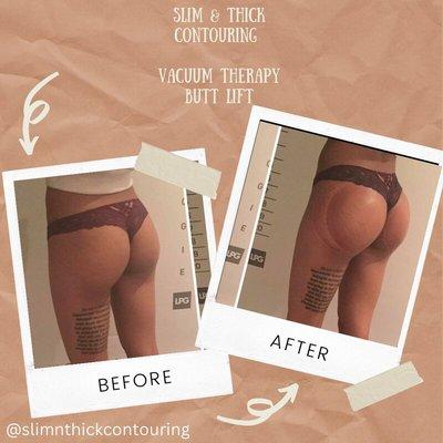 Vacuum Therapy Butt Lifts enlarges glutes for a rounder buttock! This procedure is equivalent to 1,500 squats per session.