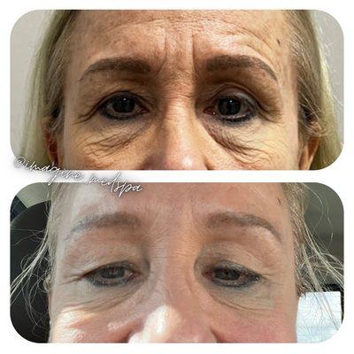 Neurotoxin for the Win!!! Under eye darkness & puffiness gone. The look of rested and refreshed in one treatment! Botox or Dysport!!!