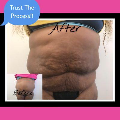 My client trusted the process.  We can help you rid belly fat safe and all natural.  Contact us today!