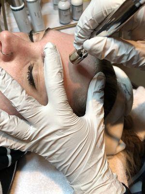 Microdermabrasion