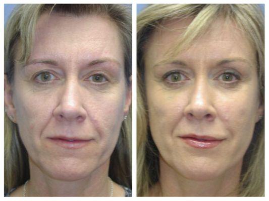 Fat Grafting Before and After Results by Haven J. Barlow, MD, FACS