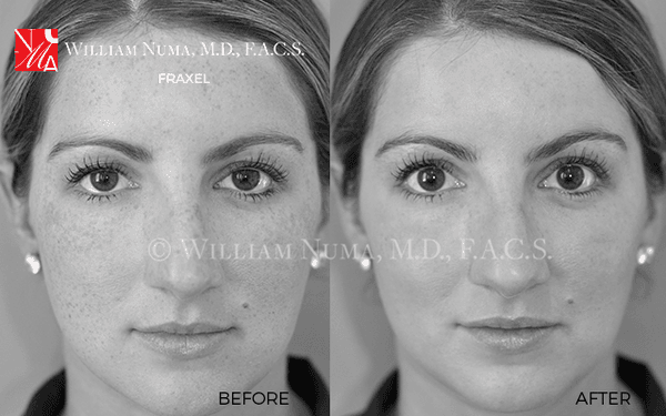 Fraxel targets fine lines and wrinkles, irregular skin texture, acne scars, stretch marks, and post procedural scars.