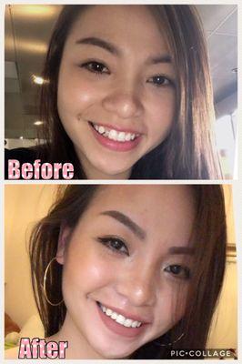 My before and after photo of my "weird" teeth lol. Big thanks to Dr. Aung, you did made me look prettier.