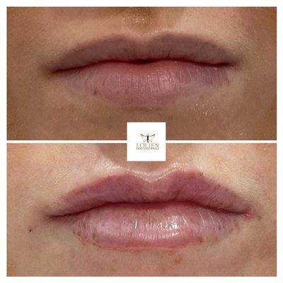 Service : Luscious Lips with Filler