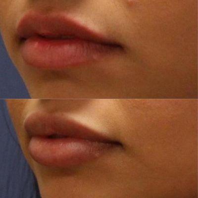 Lip Filler - Lip Plumping