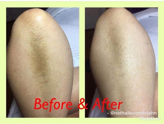 Remove dark spots from your skin. Show your soft and clear elbows!!