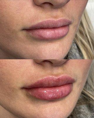 Lip filler by Cam! (If you are very sensitive like me, ask for a "dental block" to numb your lips!)