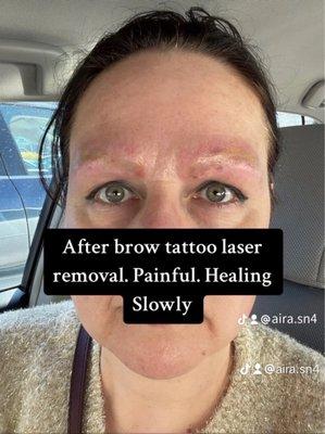 Right after brow tattoo laser removal. Painful healing