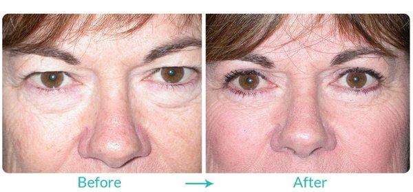 Before and After: Blepharoplasty (Excess Eyelid Skin) by Dr. Steven C. Dresner