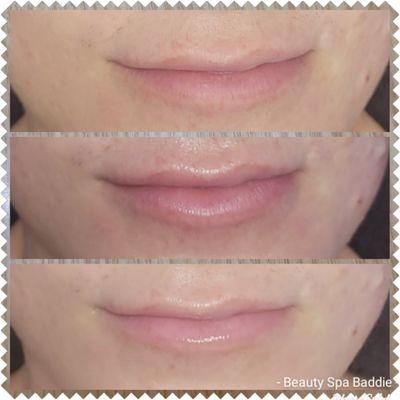 Before, during, and after Hydrafacial Lip Perk