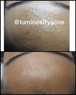 Acne Treatment results at Luminosity Acne Skincare.