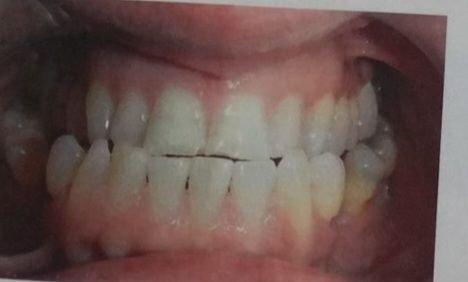 Old bite and alignment before orthodontic braces, jaw surgery followed by an all on 4 on my bottoms and finished crowns on top